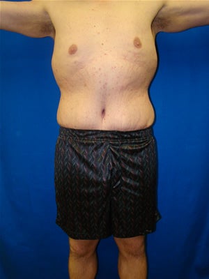 Male Tummy Tuck Surgery (abdominoplasty) Solana Beach, California after 131612