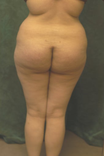 Buttocks Augmentation 518110
