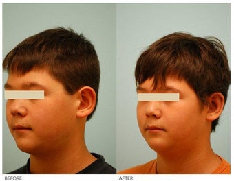 Otoplasty (Cosmetic Ear Pinning) before 136392