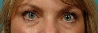 Restylane Filler for cheeks and eyes before 286176