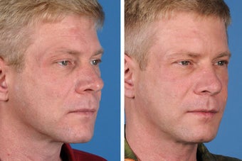 Radiesse, Restylane, Juvederm Plus & Botox Cosmetic 356492