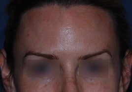 Botox after 555513