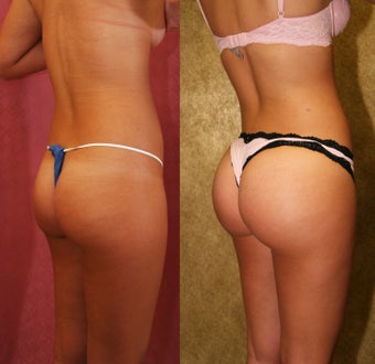Brazilian Butt Lift after 637891