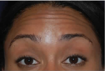Botox to Treat Horizontal Forehead Lines before 53757