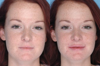 Juvederm Lip Augmentation before 380042
