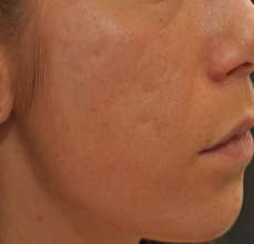 Acne Scarring 426033