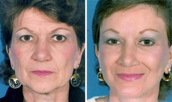 Cheek Lift and Augmentation before 296646