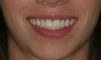 Aesthetic Implants after 213052