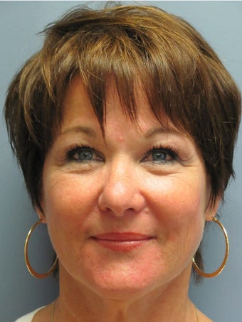Neck Lift, Platysmaplasty before 634733