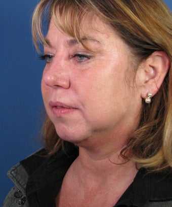 Chin Implant 550579