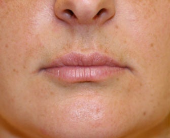 Modified lip lift before 299924