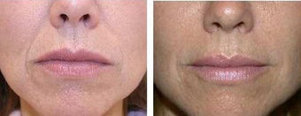Restylane for nasal labial folds before 60634