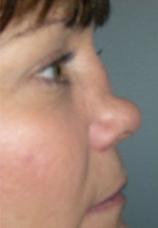 Rhinoploasty before 229739