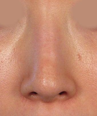 Revision Rhinoplasty after 410604
