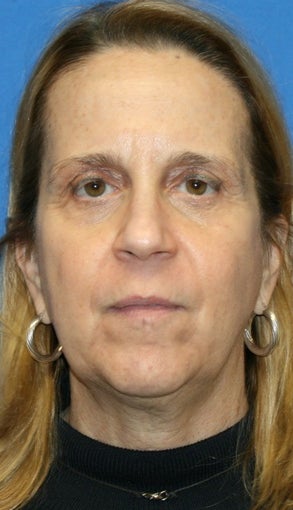 5 months post-op: Facelift, Necklift, Full Face Fat Transfer, and Lower Eyelid Skin Pinch before 385690