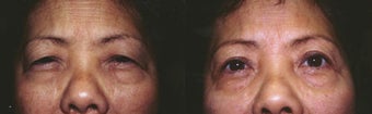 Asian upper blepharoplasty before 210099