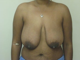 Mastopexy, breast lift before 365124