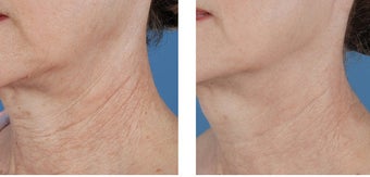 Active FX Fractional Laser Resurfacing before 253988
