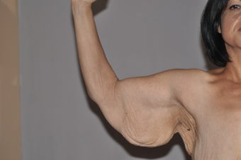 Arm Lift-Brachioplasty before 607363