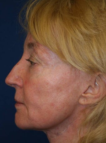 Sculptra Liquid Lift after 137175