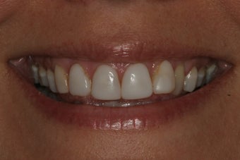 Smile Makeover with 8 Veneers before 206797