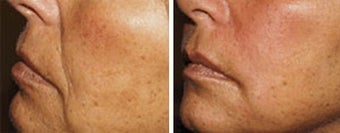 Sculptra for facial wrinkles before 6550
