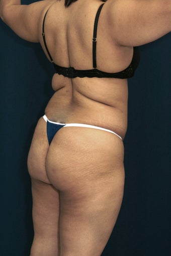 Brazilian Butt Lift surgery (liposuction to multiple areas and fat grafting to buttock) before 606611