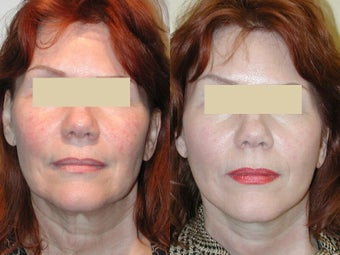 Mini jowl and neck lift - SLUPlift after 136277