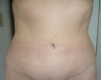 Smartlipo / liposuction after 166270