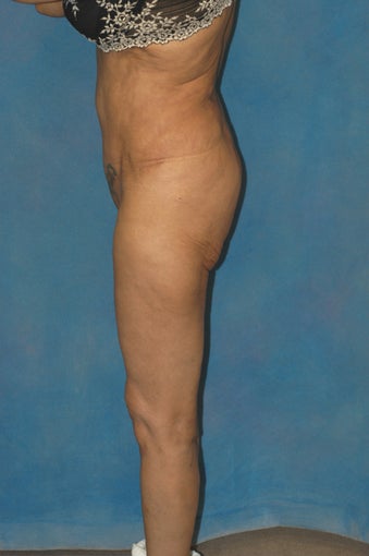 Women's Buttocks Augmentation before 518128