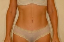 Liposuction and Abdominoplasty after 74760