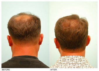 Crown (Vertex) Hair Transplant before 134775