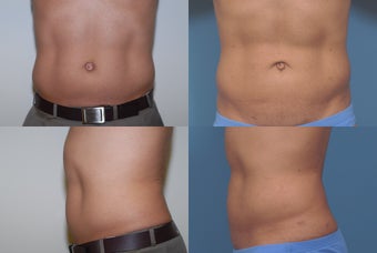 Smartlipo before 409360