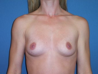 Breast Augmentation with moderate profile silicone implants before 88333