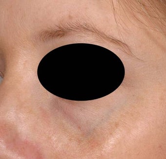 Bue veins under eyes before 136693