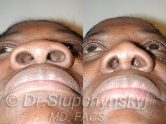 African American Rhinoplasty 525577