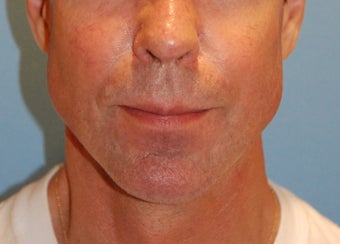 Jaw Augmentation with Implant after 139012