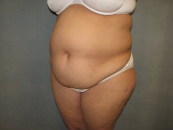 Tummy Tuck before 127655