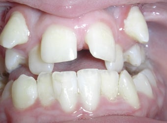 Damon Braces before 378589