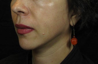 Facelift after 246964