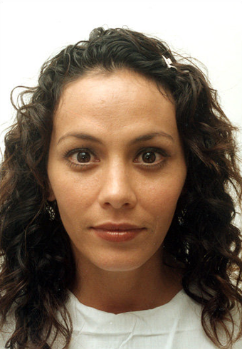 endoscopic brow-lift, upper and lower lid blepharoplasty, septorhinoplasty and lipo transfer to the midface area after 301281