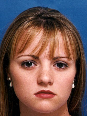 Rhinoplasty with refinement of the nasal tip and nasal dorsum and lip augmentation with placement of Alloderm grafts. ( before 249106