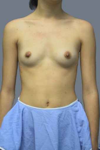 Breast augmentation /implant before 539096