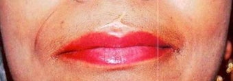 Revision of right nasolabial fold scar that was 4cm in total length before 410011