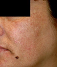 Melasma Treatment before 120084