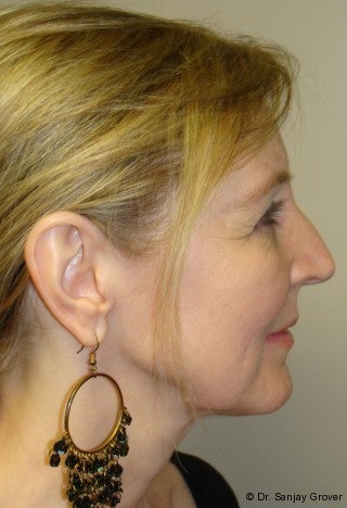 Facelift with browlift and lower blephorplasty 617176