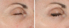 Ultherapy of Eyes and Neck before 561149