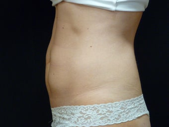 CoolSculpting after 402096