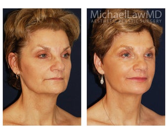 Facial Rejuvenation - Neck Lift after 395452