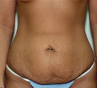 Tummy Tuck (Abdominoplasty) before 74761